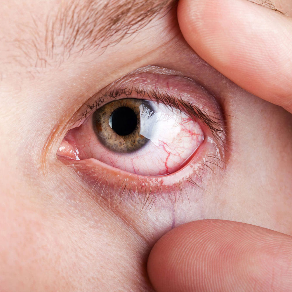 Fides Dry eyes treatment
