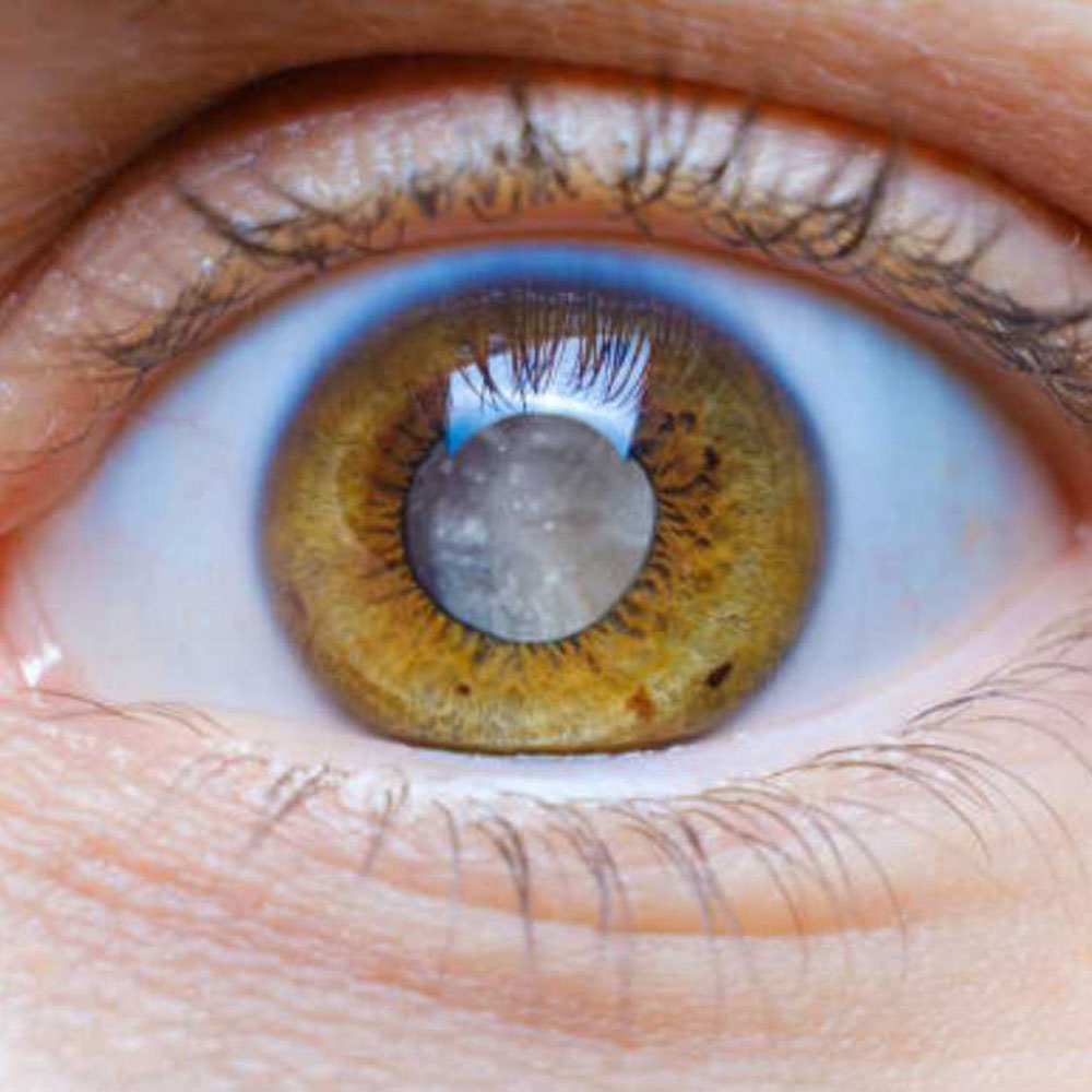 Fides glaucoma treatment