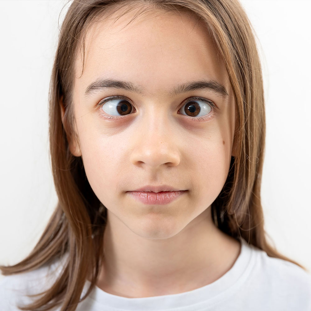 Fides Squint treatment